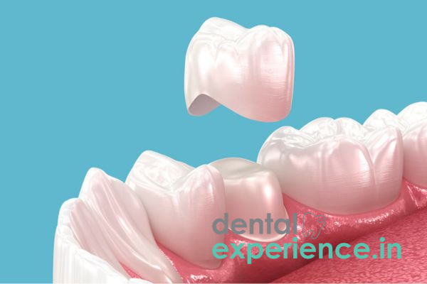 5 Signs You Need a Dental Crown