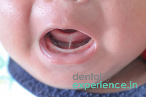Understanding Tongue-Tie in Infants and Toddlers