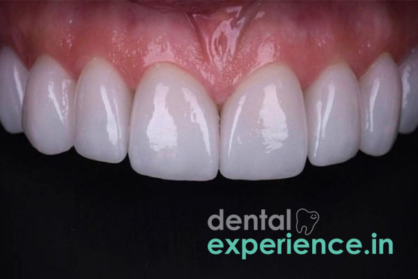 Easy Steps To Fix Yellow-Crooked Teeth Instantly With Porcelain Veneers!