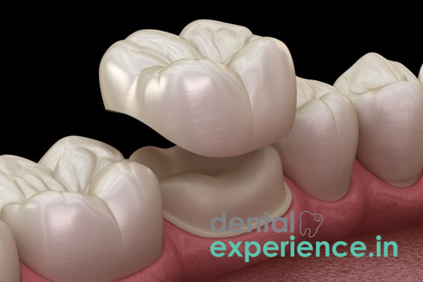 4 Reasons Why Your Dental Crowns Need to Be Replaced